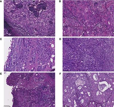 Clinicopathologic and Genomic Features in Triple-Negative Breast Cancer Between Special and No-Special Morphologic Pattern